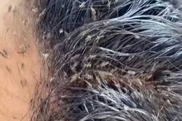 Is this the worst head lice outbreak ever? Hundreds of nits infest a girl in a video