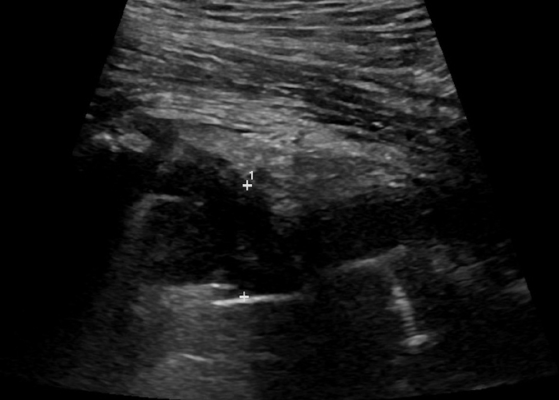 Hip Ultrasound Scan: What You Need To Know