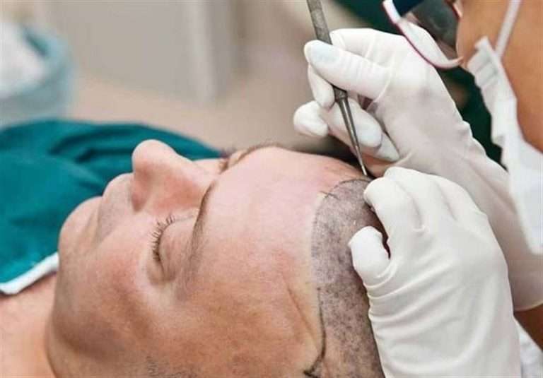 Mid-Hair Transplants for Men: Balancing Health and Aesthetic Goals