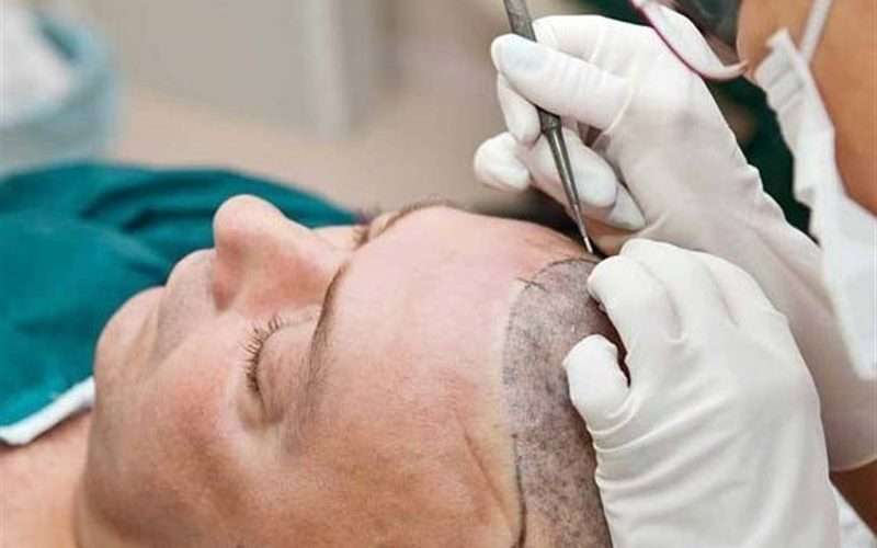 Mid-Hair Transplants for Men: Balancing Health and Aesthetic Goals